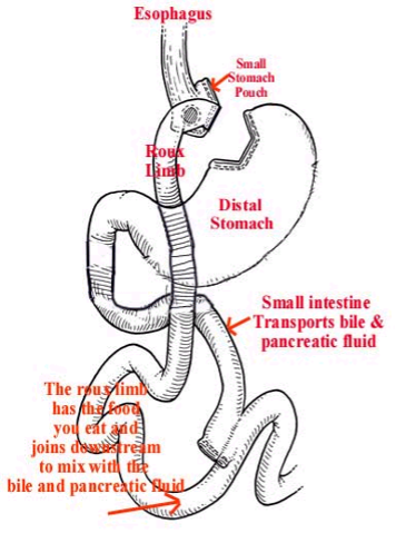 Oklahoma City Gastric Bypass