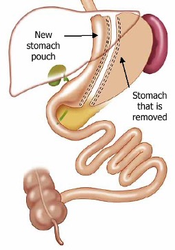 Gastric Sleeve Surgery OKC